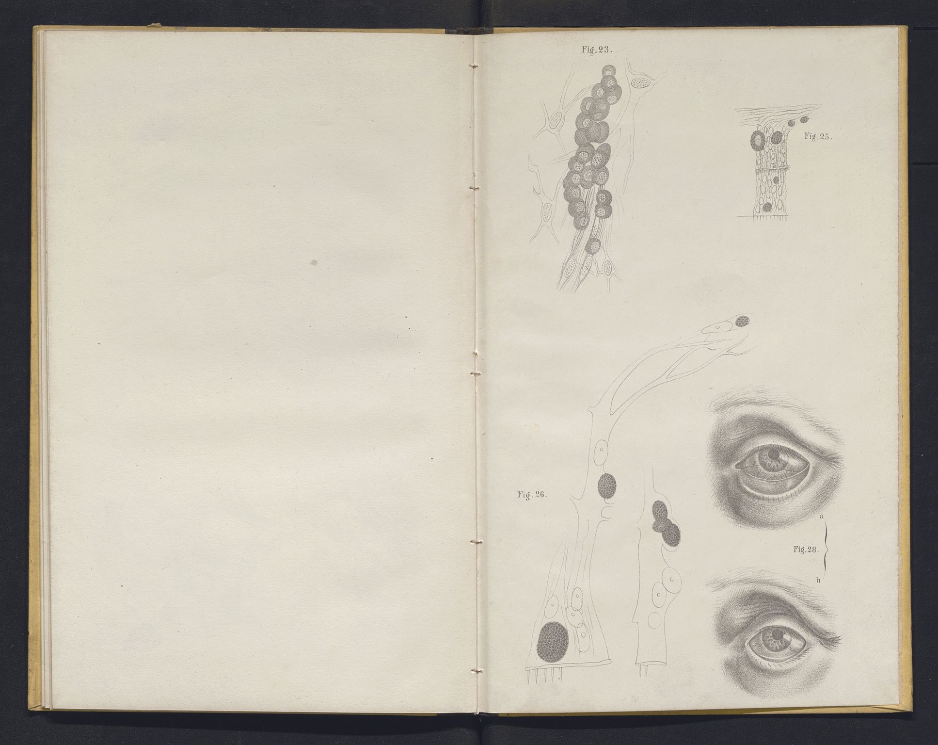 Lepraarkiver - Overlegen for den spedalske sykdom, AV/SAB-A-61001/E/L0001: The Leprous Diseases of the Eye with 6 colored plates by Dr. O.B. Bull and Dr. G.A. Hansen, 1873