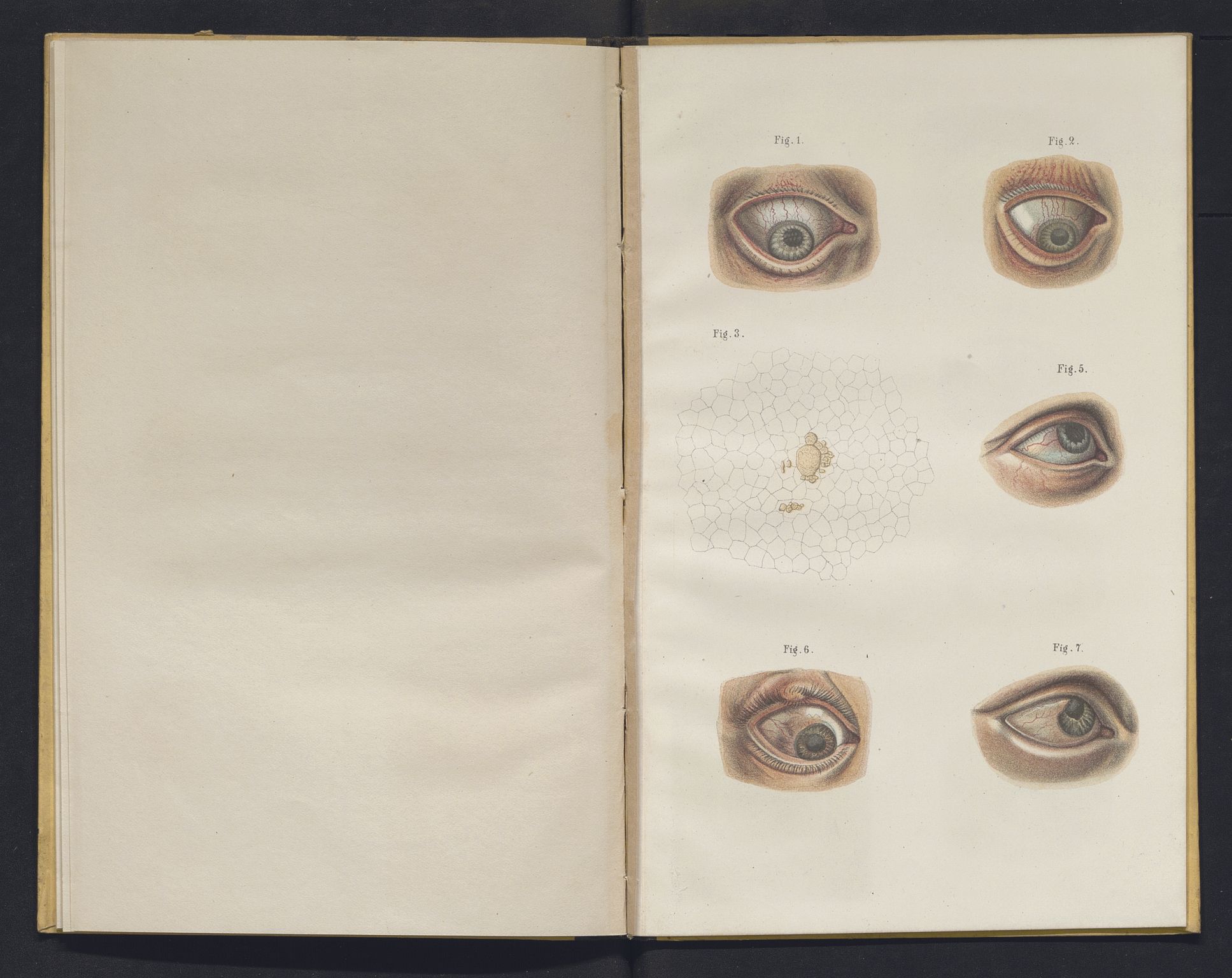 Lepraarkiver - Overlegen for den spedalske sykdom, AV/SAB-A-61001/E/L0001: The Leprous Diseases of the Eye with 6 colored plates by Dr. O.B. Bull and Dr. G.A. Hansen, 1873