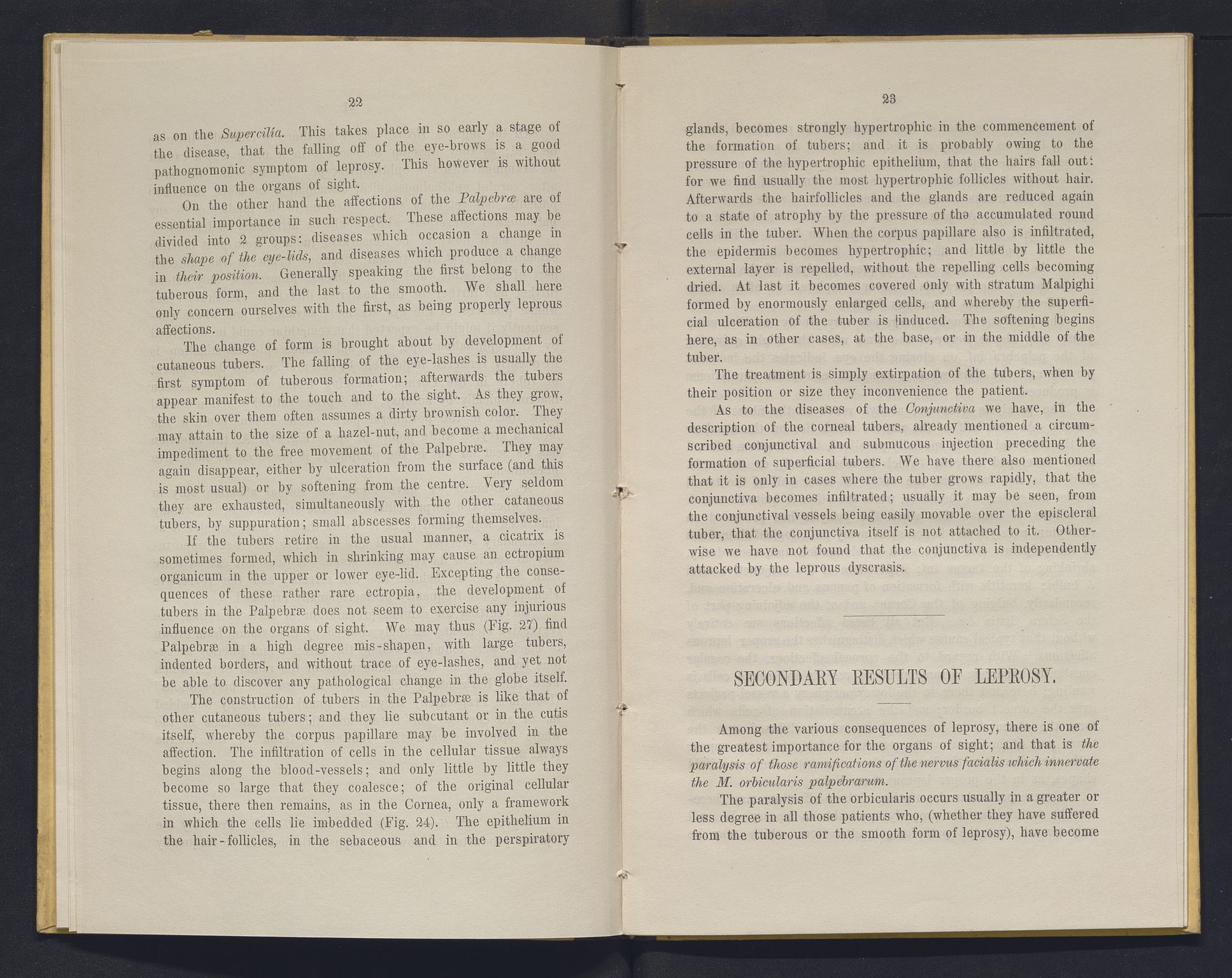 Lepraarkiver - Overlegen for den spedalske sykdom, AV/SAB-A-61001/E/L0001: The Leprous Diseases of the Eye with 6 colored plates by Dr. O.B. Bull and Dr. G.A. Hansen, 1873, p. 22-23