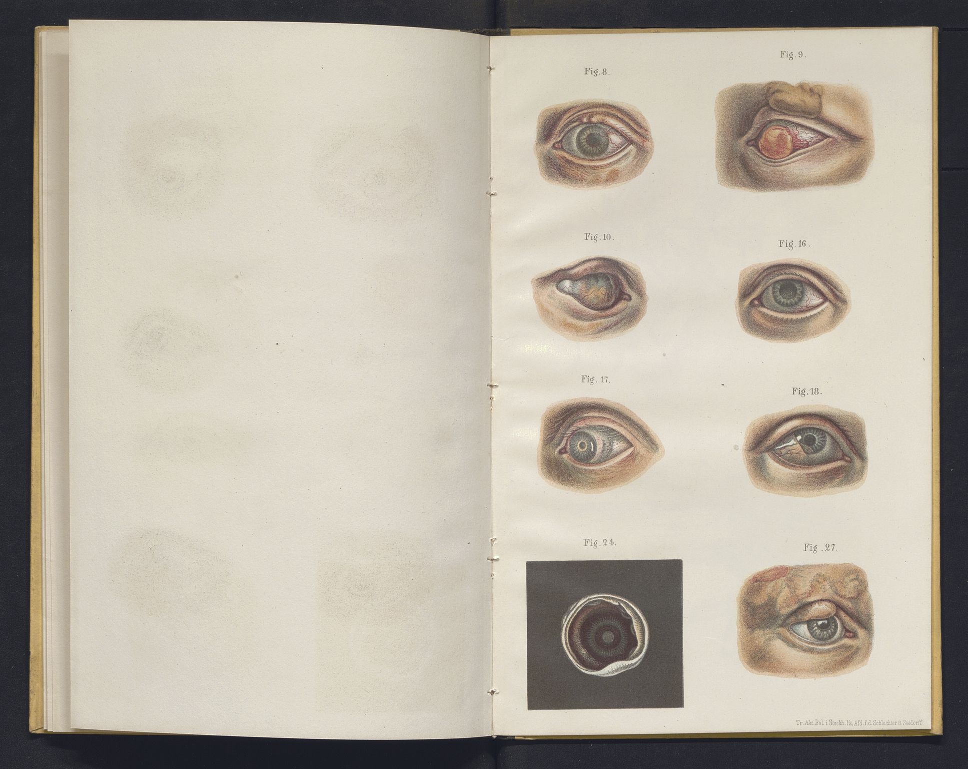 Lepraarkiver - Overlegen for den spedalske sykdom, AV/SAB-A-61001/E/L0001: The Leprous Diseases of the Eye with 6 colored plates by Dr. O.B. Bull and Dr. G.A. Hansen, 1873