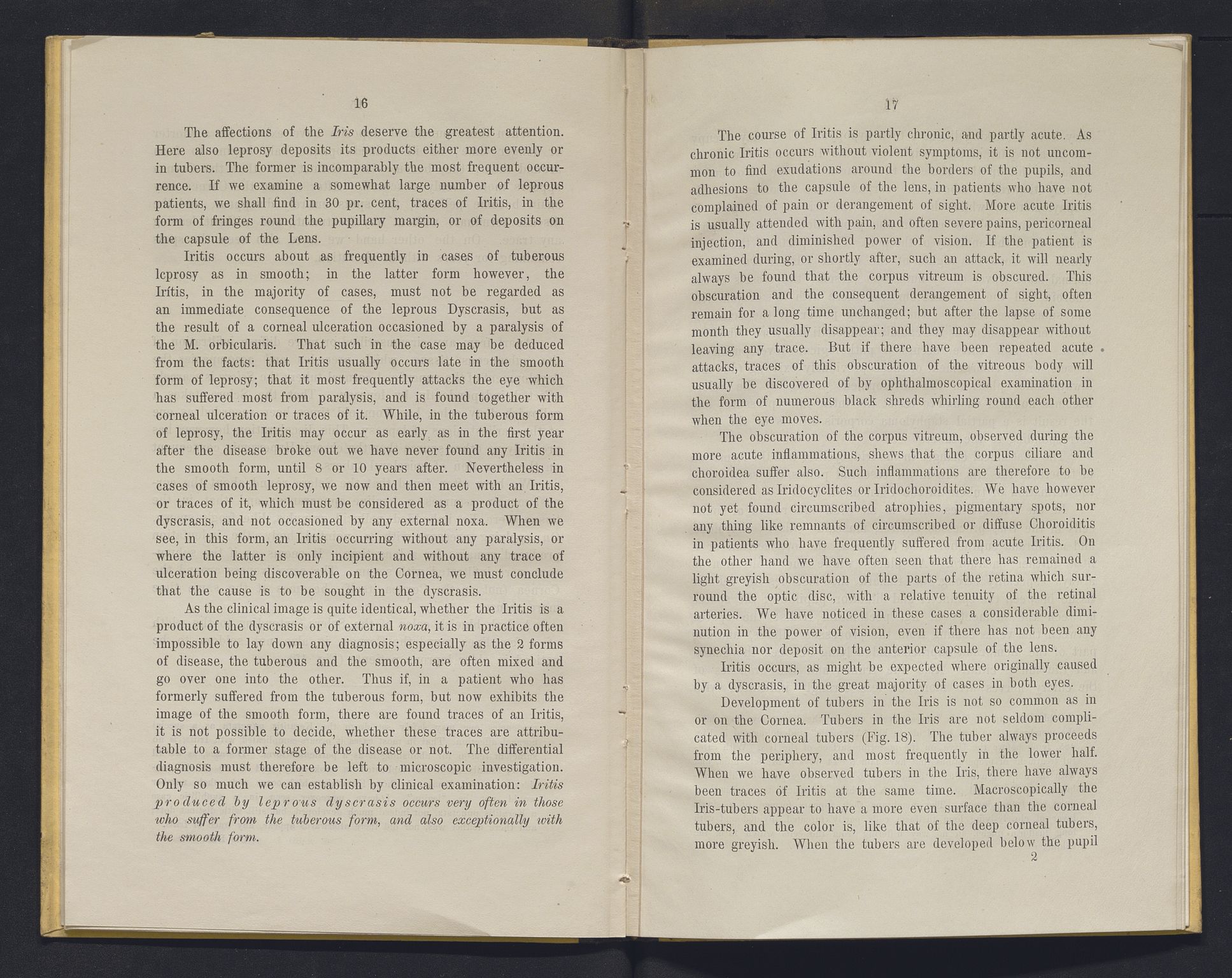 Lepraarkiver - Overlegen for den spedalske sykdom, AV/SAB-A-61001/E/L0001: The Leprous Diseases of the Eye with 6 colored plates by Dr. O.B. Bull and Dr. G.A. Hansen, 1873, s. 16-17