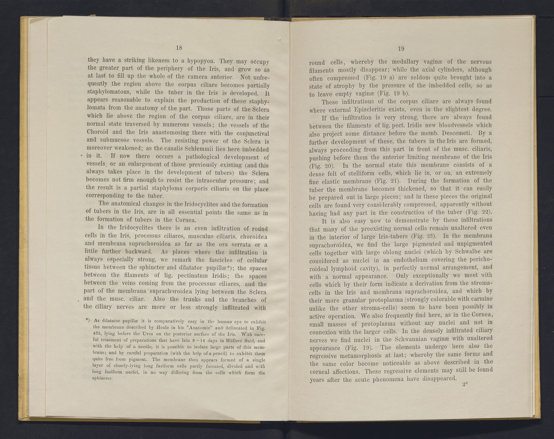 Lepraarkiver - Overlegen for den spedalske sykdom, AV/SAB-A-61001/E/L0001: The Leprous Diseases of the Eye with 6 colored plates by Dr. O.B. Bull and Dr. G.A. Hansen, 1873, s. 18-19