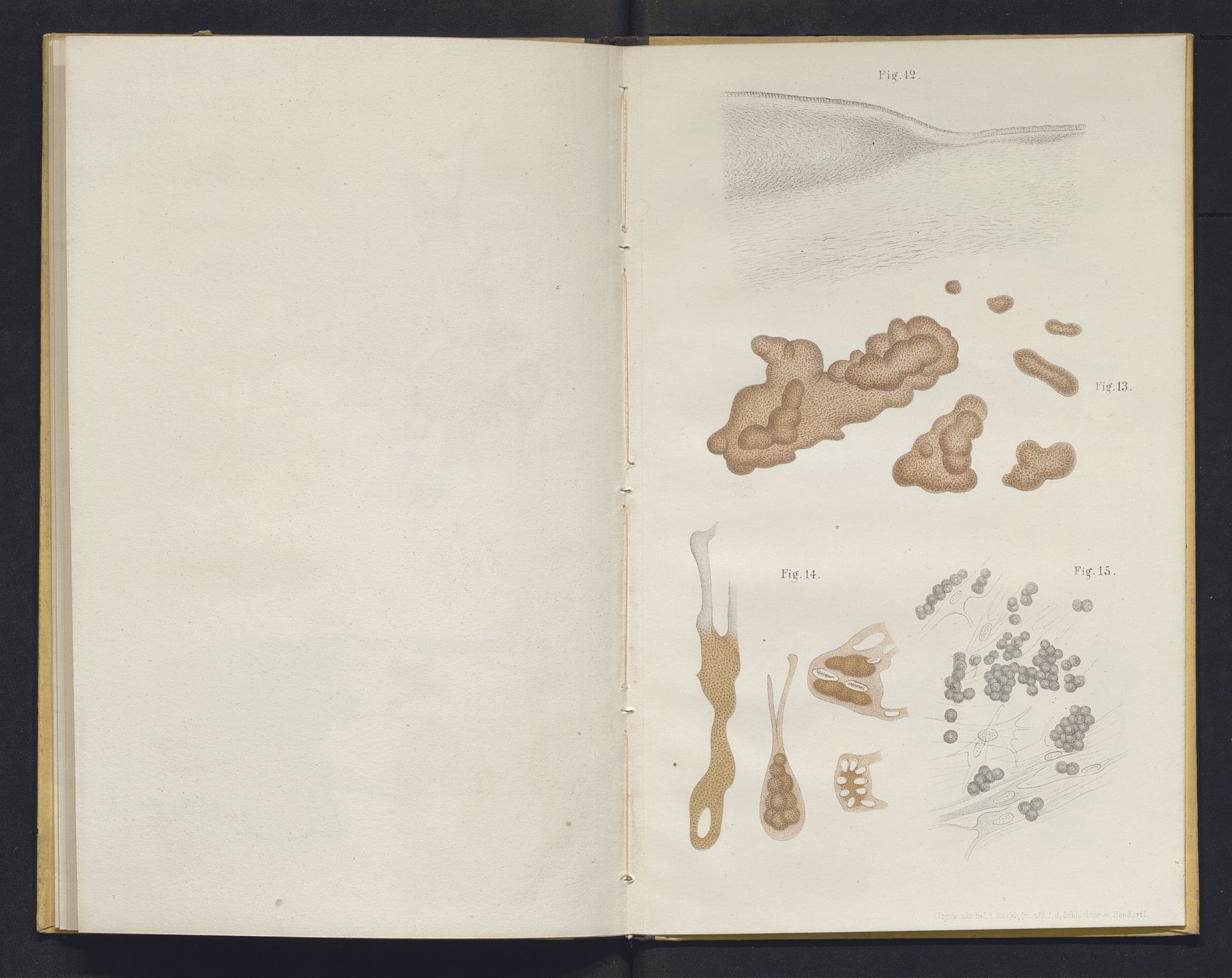 Lepraarkiver - Overlegen for den spedalske sykdom, AV/SAB-A-61001/E/L0001: The Leprous Diseases of the Eye with 6 colored plates by Dr. O.B. Bull and Dr. G.A. Hansen, 1873